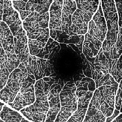 OCT Angiographie OCT Angiographie